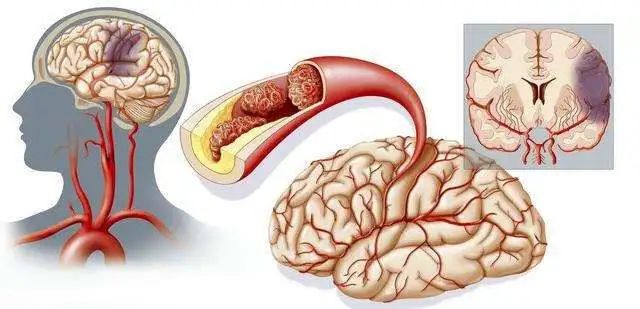 NMN prevents cerebral infarction