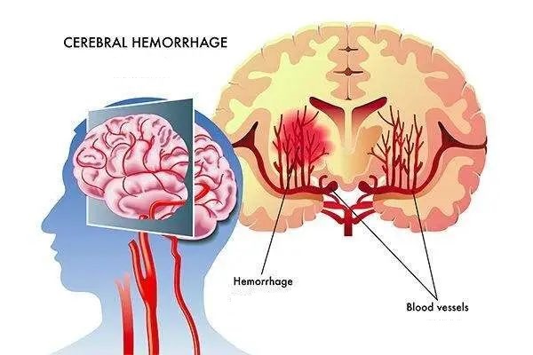 NMN reduces cerebral hemorrhage injury