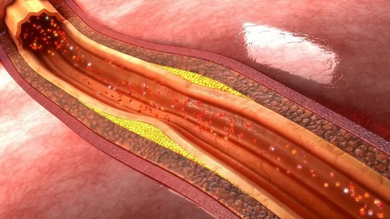 NMN prevents arteriosclerosis